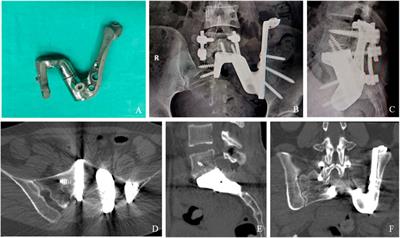Reconstruction after hemisacrectomy with a novel 3D-printed modular hemisacrum implant in sacral giant cell tumor of the bone